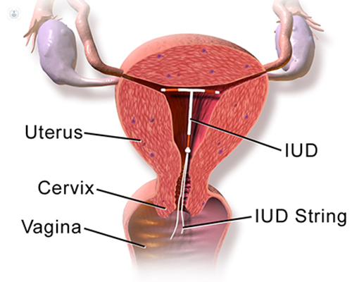 آی یو دی (دستگاه iud) چیست؟